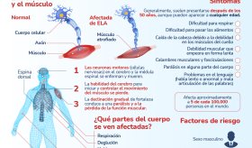 Esclerosis Lateral Amiotrófica - Infografía