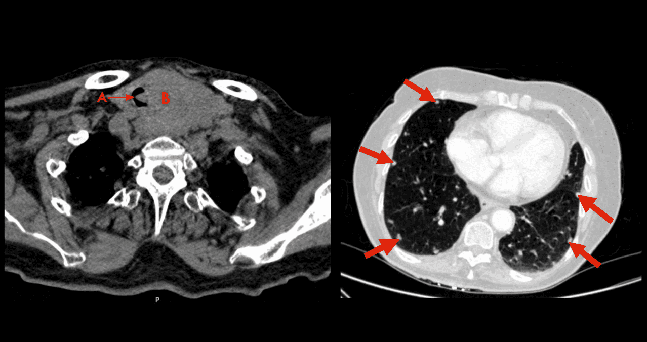 Report a patient with metastatic renal cell carcinoma of the respiratory tract and thyroid gland