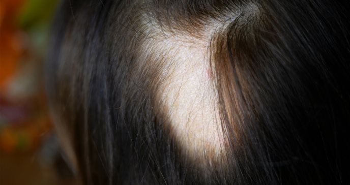 Minoxidil oral para tratamiento de la alopecia: factores a tener en cuenta