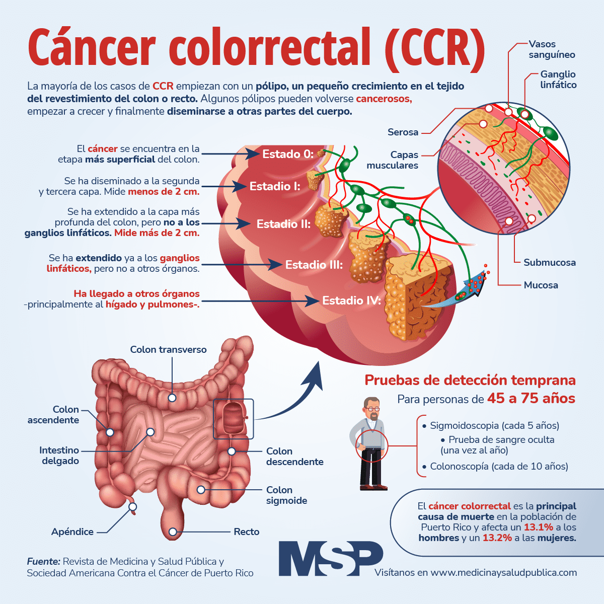 Cáncer Colorrectal Infografía