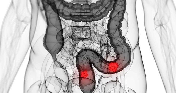 Cáncer de colon: Los síntomas de alerta de un tumor agresivo