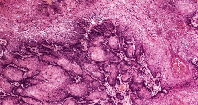 Advierten investigadores: Virus del Papiloma Humano podría desarrollar cáncer en hombres