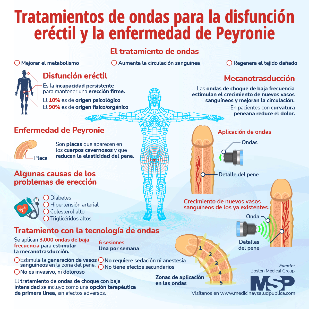 Tratamiento De Ondas Para La Disfunción Eréctil Y La Enfermedad De