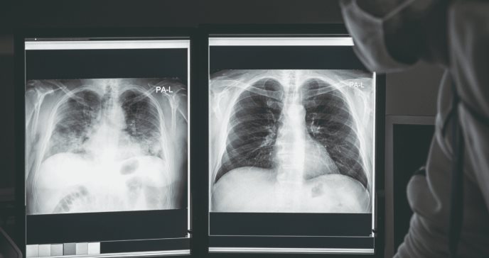 ¿Cómo reconocer precozmente la enfermedad pulmonar intersticial asociada con anticuerpos de miositis?