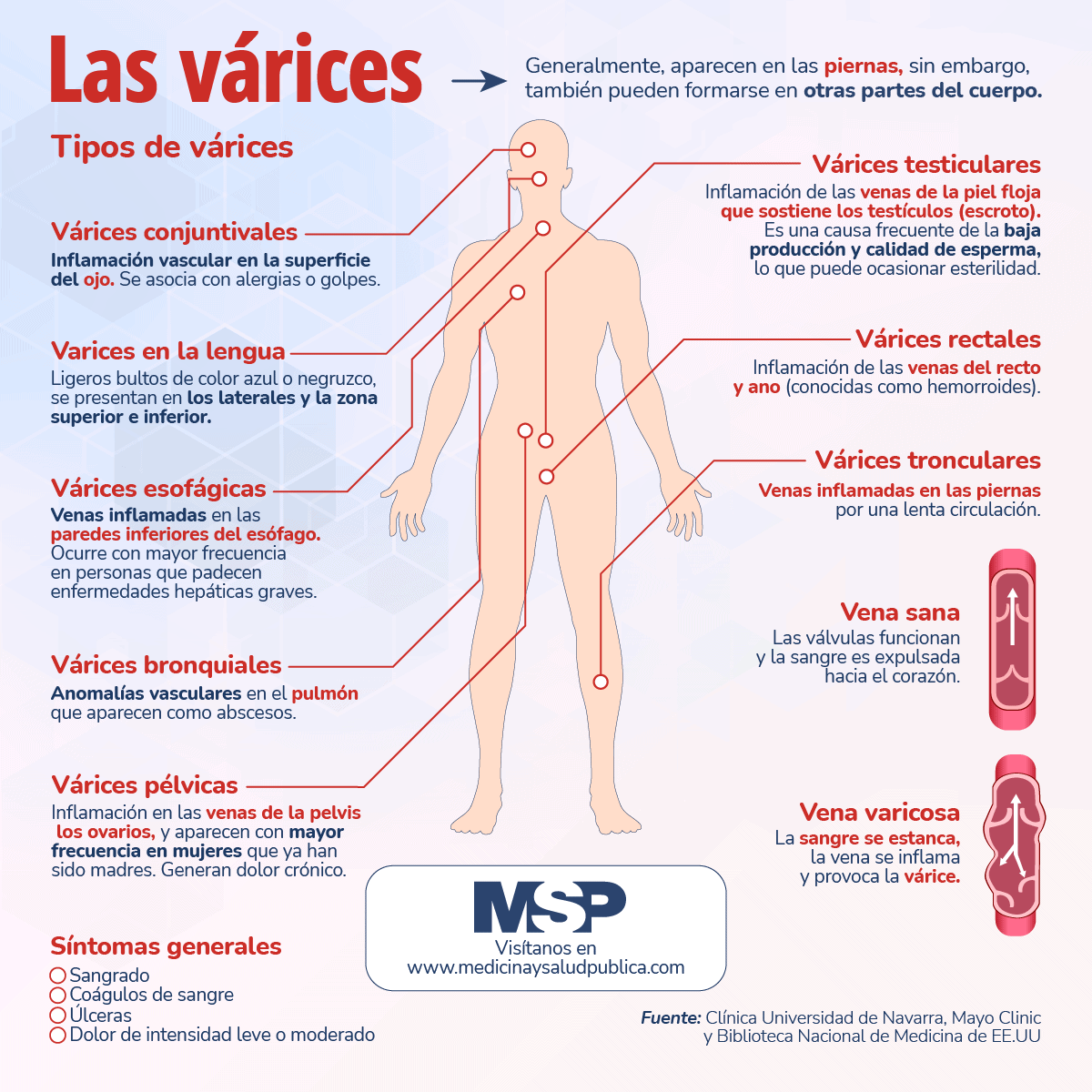 Las Varices Infografía 1611