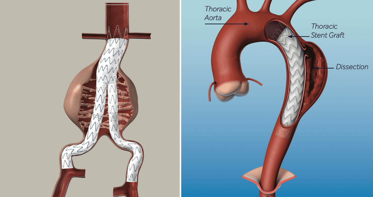 Gli aneurismi dell’aorta addominale sono nemici silenziosi e hanno un trattamento tempestivo