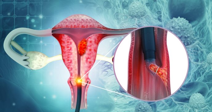 Endometriosis: síntomas, prevención y tratamientos