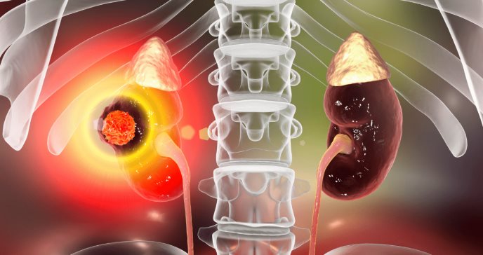 La combinación de sitravatinib y nivolumab mejora los resultados en el cáncer de riñón avanzado