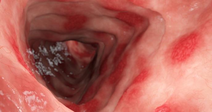 Nueva guía científica arroja luz sobre el diagnóstico y tratamiento de síndromes gastrointestinales raros
