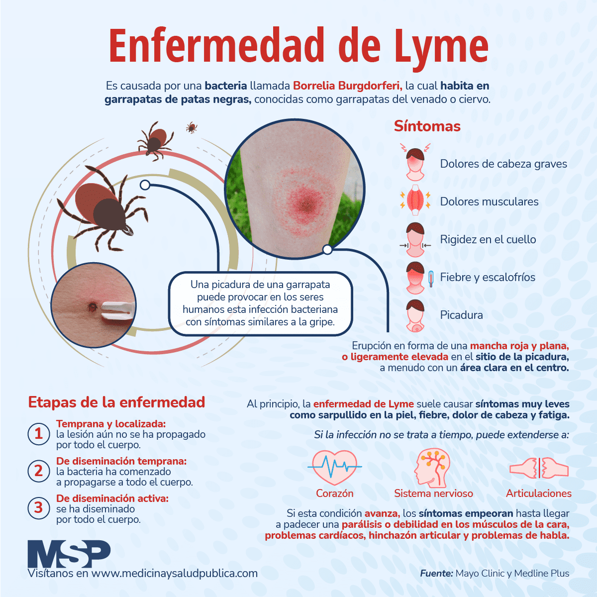 Enfermedad De Lyme Infografía