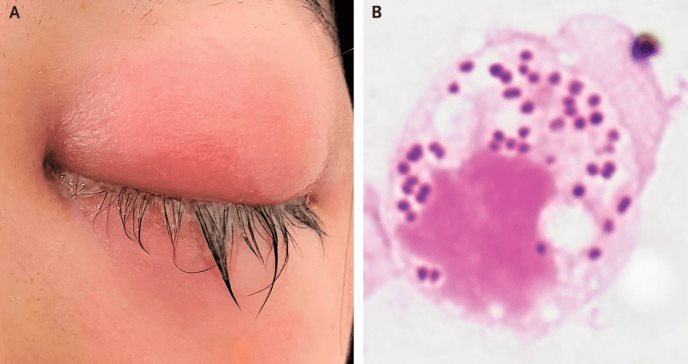 Mujer con visión borrosa y secreción purulenta presenta conjuntivitis gonocócica o gonorrea ocular