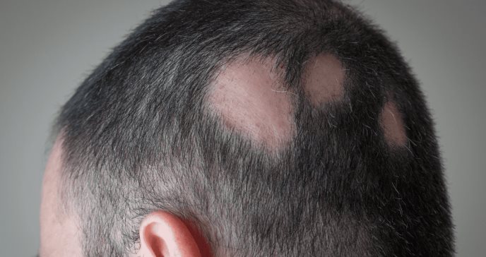 Estudio en fase 3: Baricitinib promueve el crecimiento del cabello en la alopecia areata