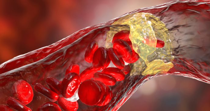 Las arterias rígidas predicen la diabetes mejor que la presión arterial