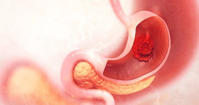 Úlceras en el estómago: causas, síntomas y tratamiento