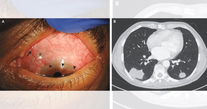 Paciente enfrenta escleroqueratitis en Granulomatosis con Poliangitis ocular 