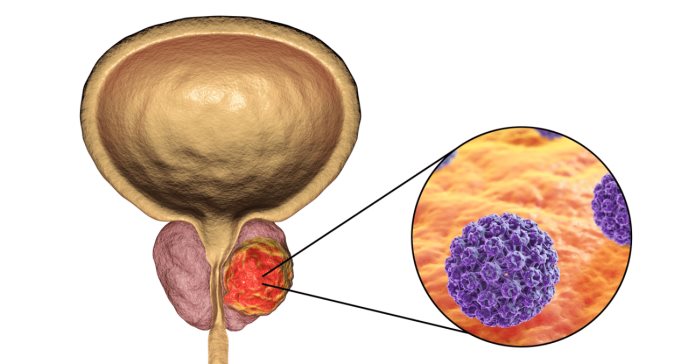 Radioterapia para el cáncer de próstata