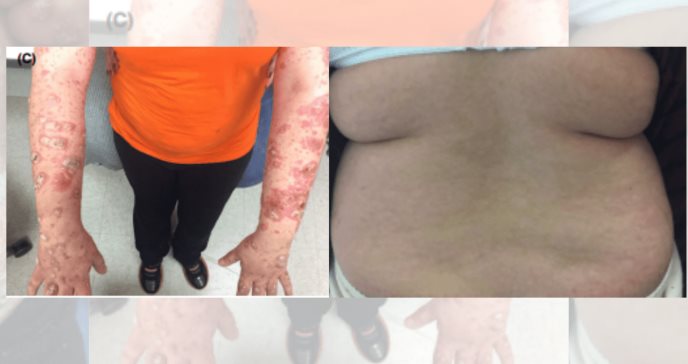 Infradiagnosticado la dermatitis atópica en niños puertorriqueños  
