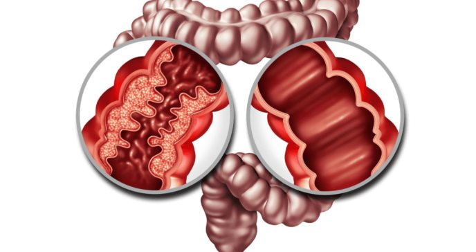 FDA aprueba risankizumab para la enfermedad de Crohn
