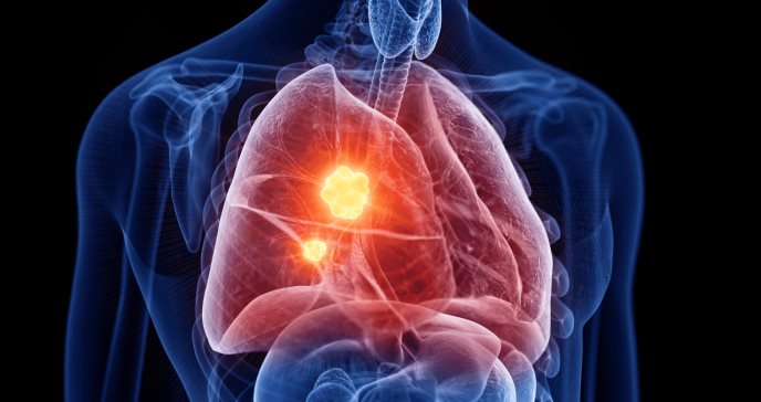 Cáncer de pulmón: síntomas, detección y tratamiento