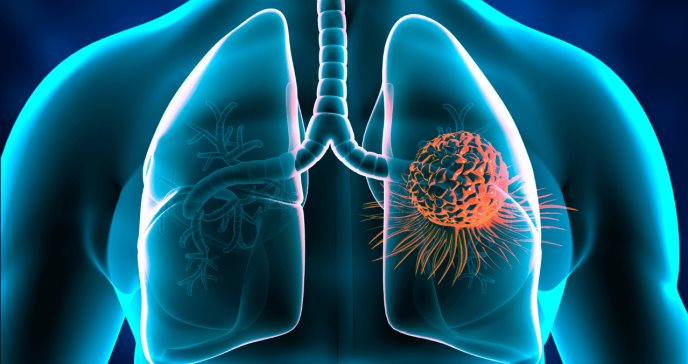 Investigan probabilidades de detectar el cáncer de pulmón con una prueba de aliento