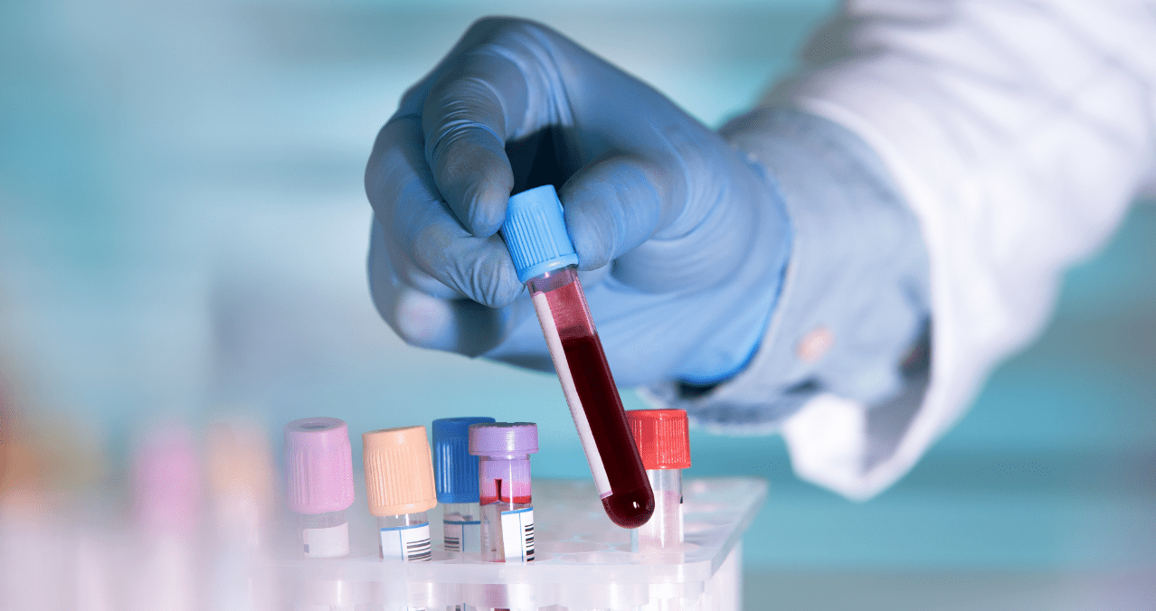 I ricercatori rivelano un modo per rilevare i biomarcatori del cancro attraverso campioni di sangue