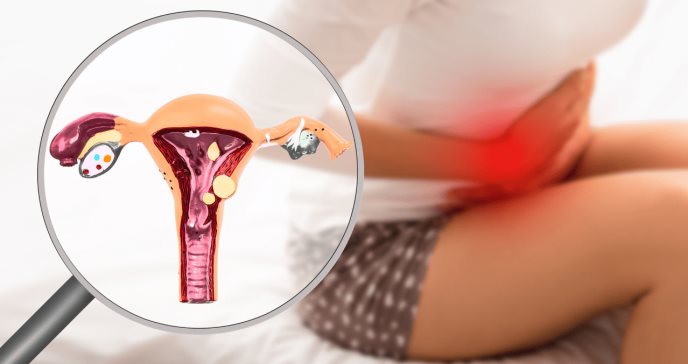 Caso clínico: encuentran endometriosis en el canal anal de mujer de 33 años