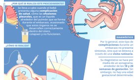 Tubo de pecho fetal intrauterino - Infografía