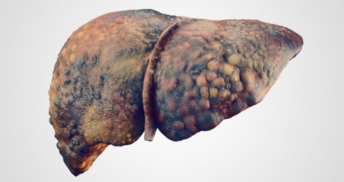 Investigan alto riesgo de cáncer de hígado residual de una cirrosis curada por Hepatitis C