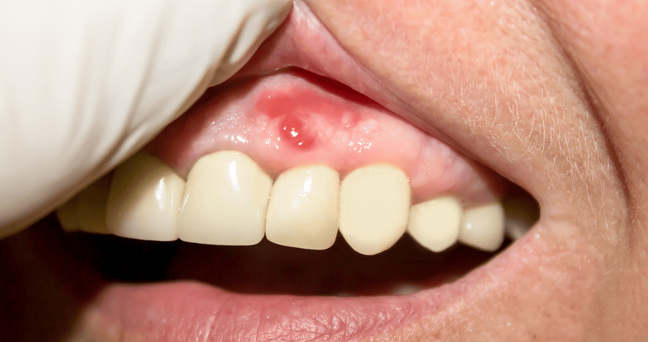 Oportuno pañuelo de papel cocodrilo Periodontitis: la grave infección en las encías que afecta más allá de la  salud bucal