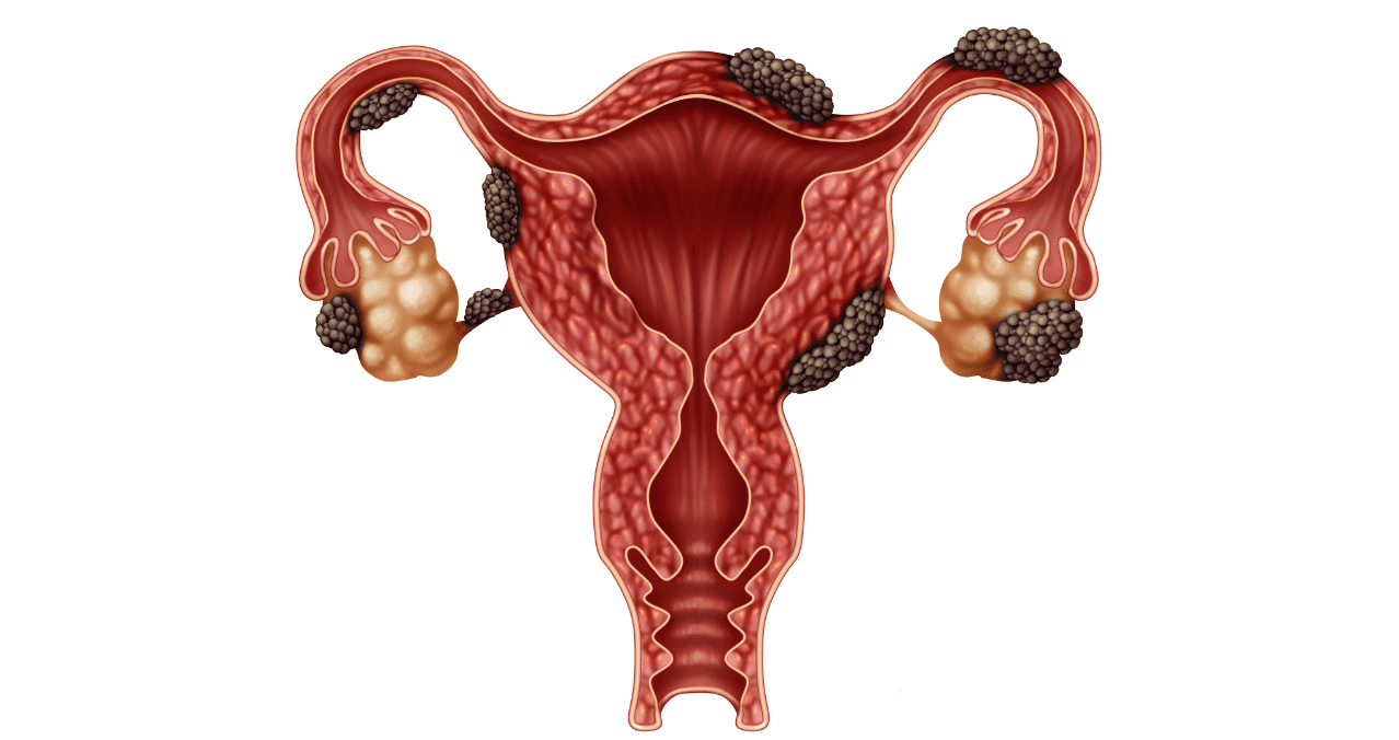La terapia combinata con relugolix allevia il dolore dell’endometriosi
