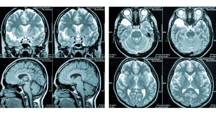 Neuroanatomía clínica de la Esclerosis Múltiple: Perspectivas y avances clínicos