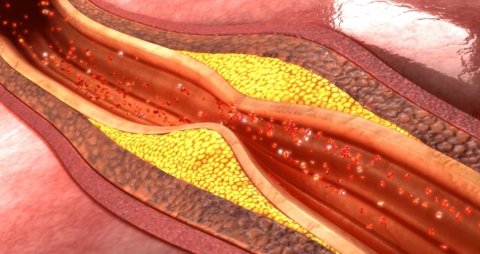 Colesterol remanente elevado aumenta el riesgo cardiovascular en pacientes con diabetes tipo 2