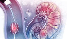 Bajos niveles de calcio y potasio estarían asociados al desarrollo de enfermedades renales