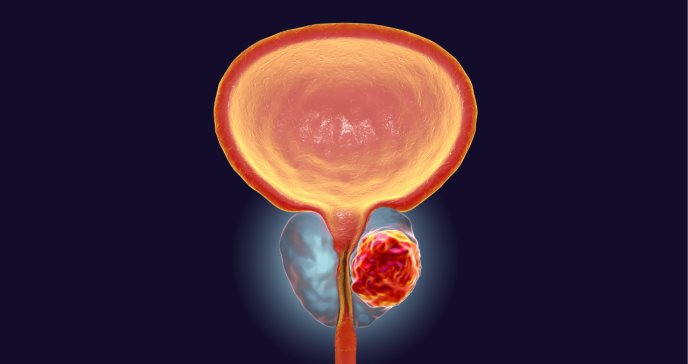 Radioterapia de próstata: riesgo para el desarrollo de un segundo cáncer primario
