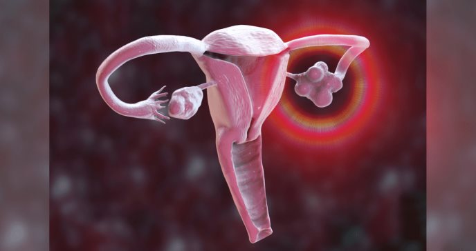 Síndrome de ovario poliquístico: factor de comorbilidad en mujeres