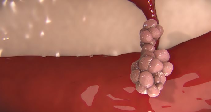 Análisis sanguíneo podría revelar características del cáncer metastásico