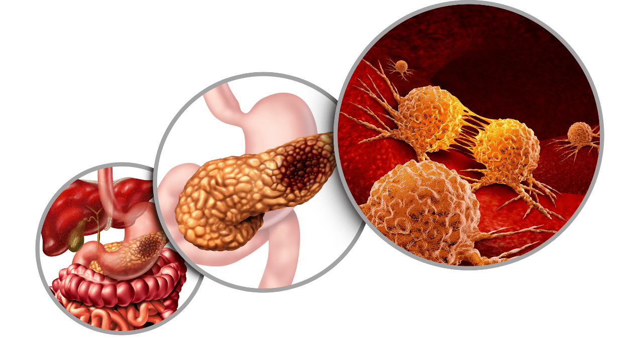 È stato trovato un raro adenocarcinoma gastrico associato ad adenocarcinoma a cellule con sigillo del pancreas