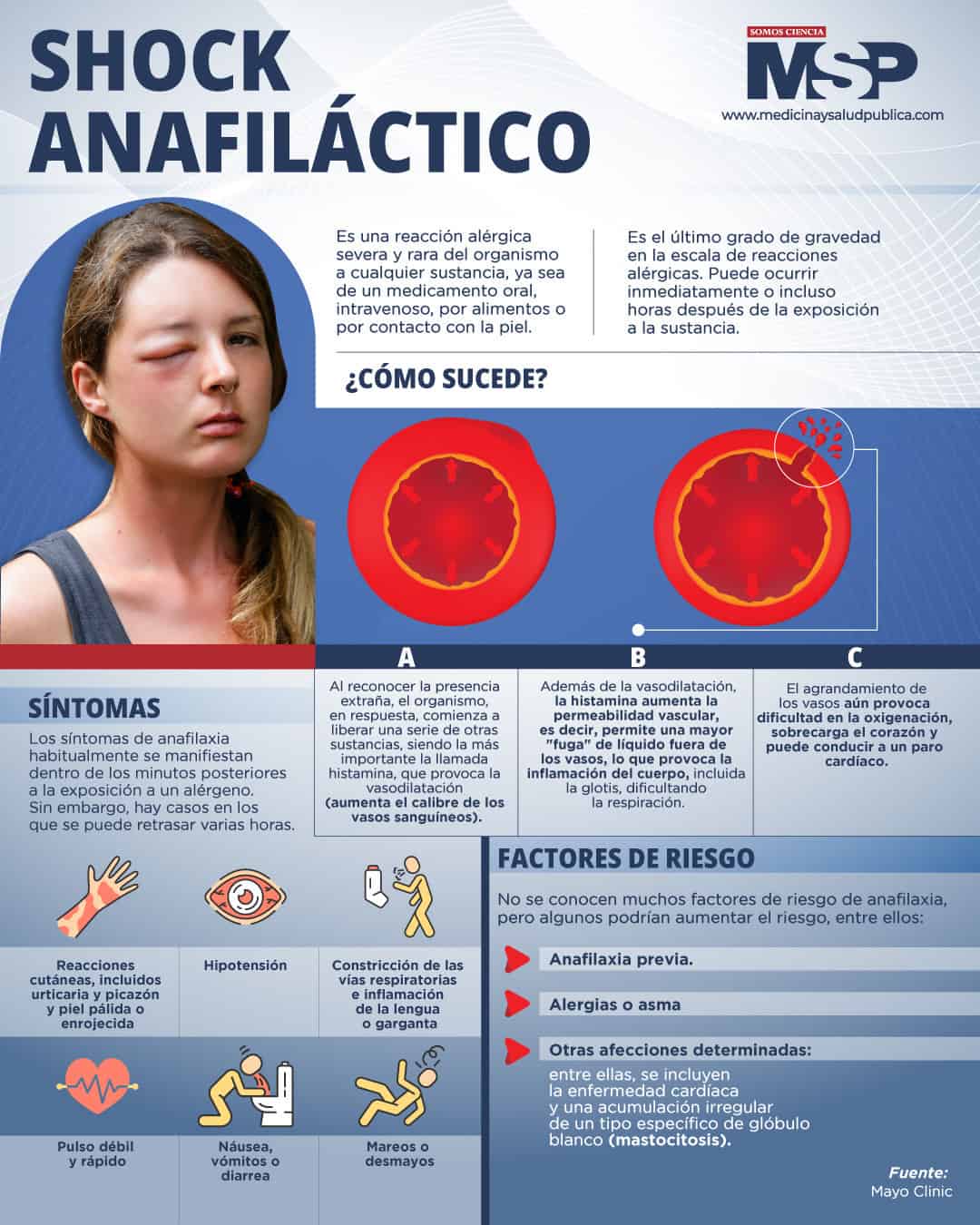 Shock Anafiláctico Infografía 