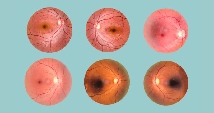 Cuatro enfermedades oculares derivadas de la diabetes