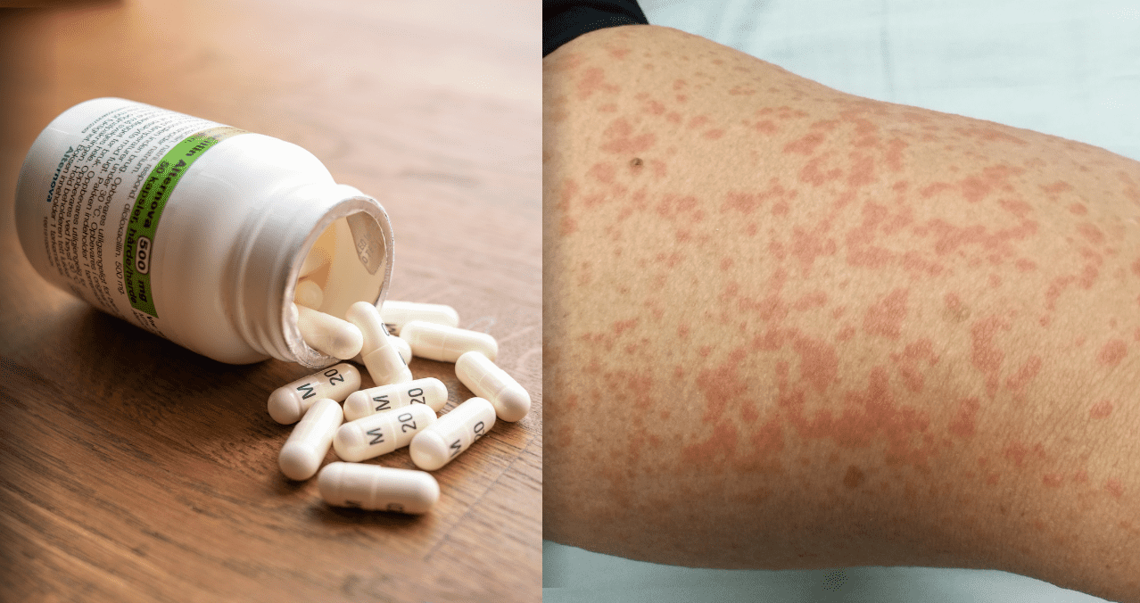 5 fatti da tenere a mente sull’allergia alla penicillina
