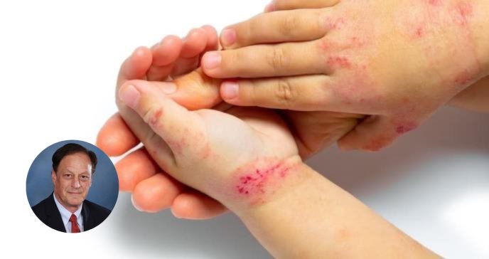 Cinco preguntas sobre la dermatitis atópica respondidas por un experto
