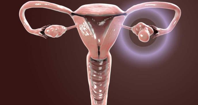Tips para mujeres con el síndrome de ovario poliquístico