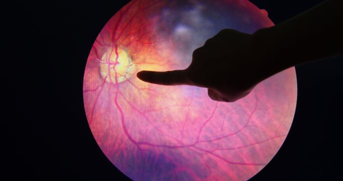 Algoritmo de aprendizaje profundo detecta retinopatía diabética en pacientes
