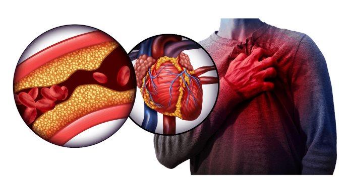 Dolor en el pecho, fatiga y otros síntomas del infarto de miocardio: conoce las causas y su tratamiento