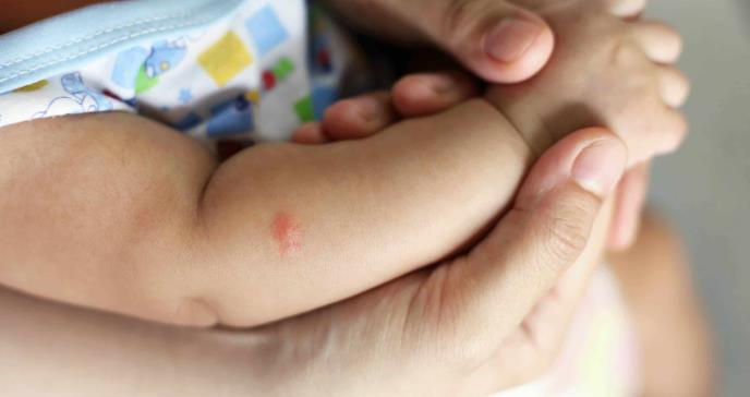 Cómo tratar las picaduras de mosquito en bebés