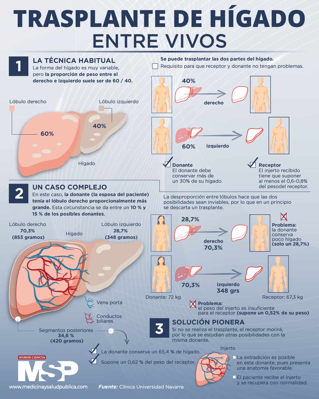 Transplante De Hígado Entre Vivos Infografía 2004