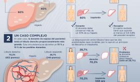 Transplante de hígado entre vivos - Infografía