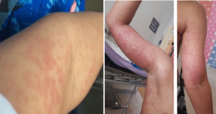 Raro caso de dermatitis por exposición a algas en Puerto Rico