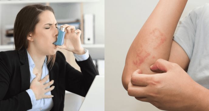 ¿Cuál es la relación entre el asma y la dermatitis atópica?