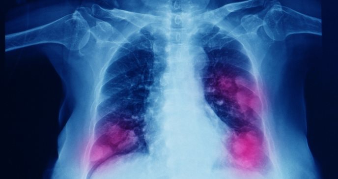 Mutaciones genéticas provocarían cáncer de pulmón en pacientes no fumadores